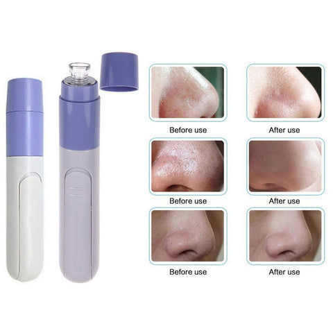 Facial Pore Cleanser – Battery-Operated Suction Skin-Care Tool, 1-Pack or 2-Pack